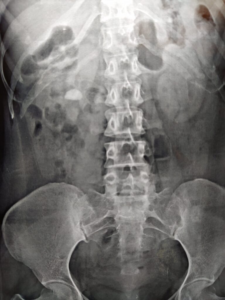 XRAY kub showing 10 mm kidney stone before mini perc mini pcnl