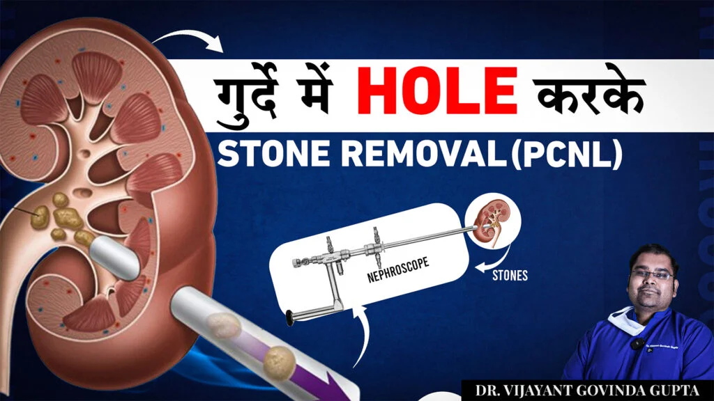 Percutaneous Nephrolithotomy (PCNL): A Comprehensive Guide (Hindi)