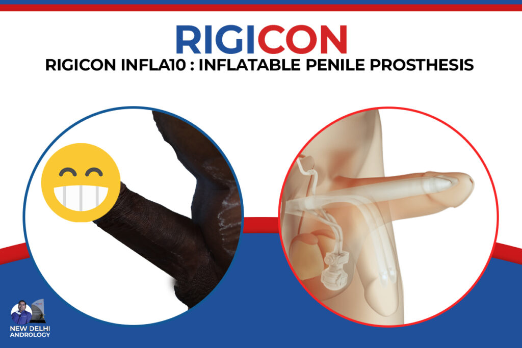 Rigicon INFLA10 - Inflatable Penile Prosthesis