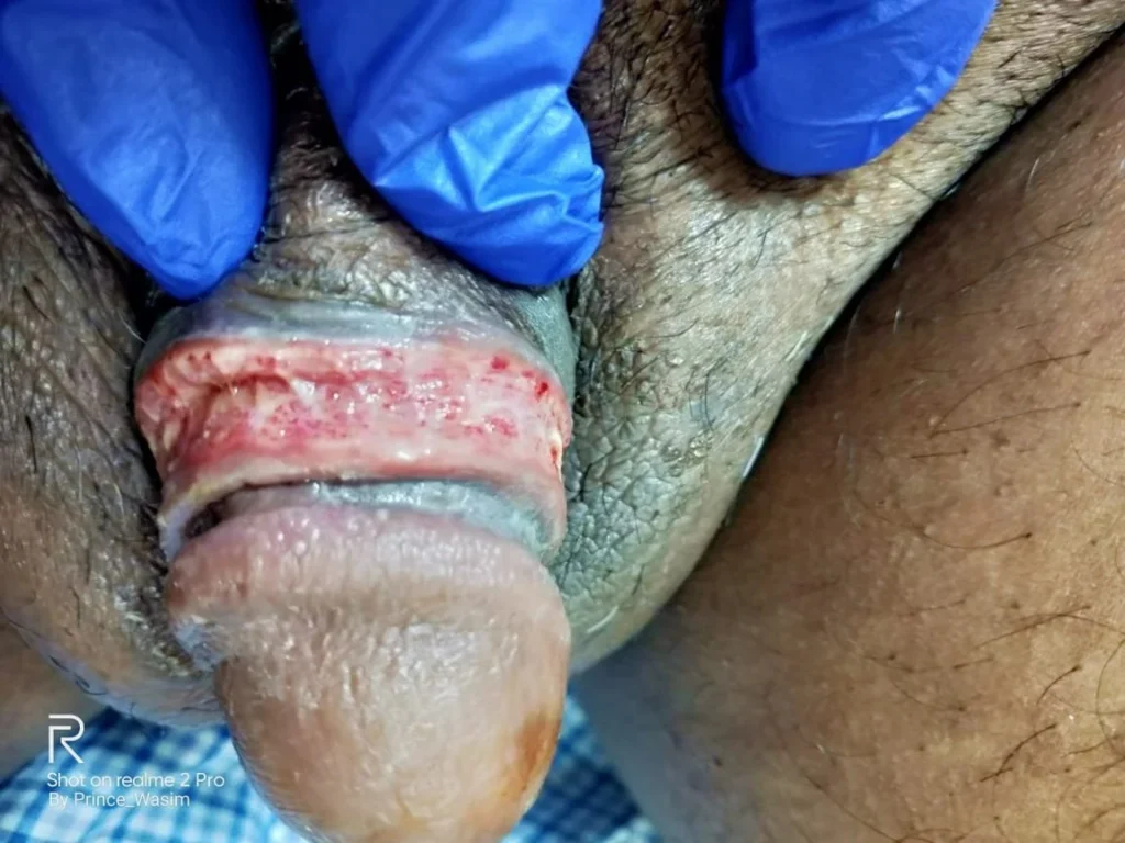 Complications of Laser Circumcision