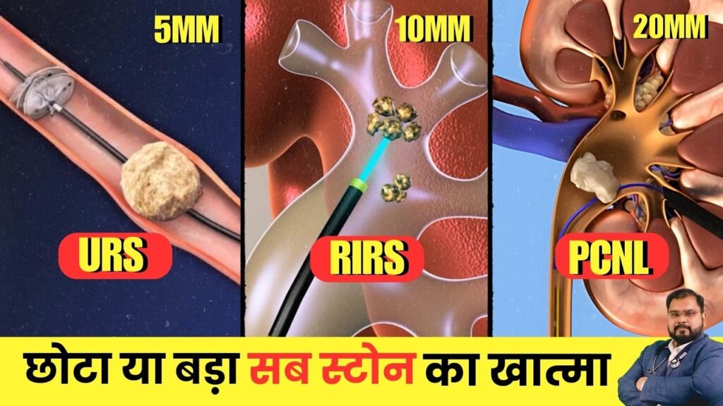 Types of Kidney Stones and Their Treatment Options